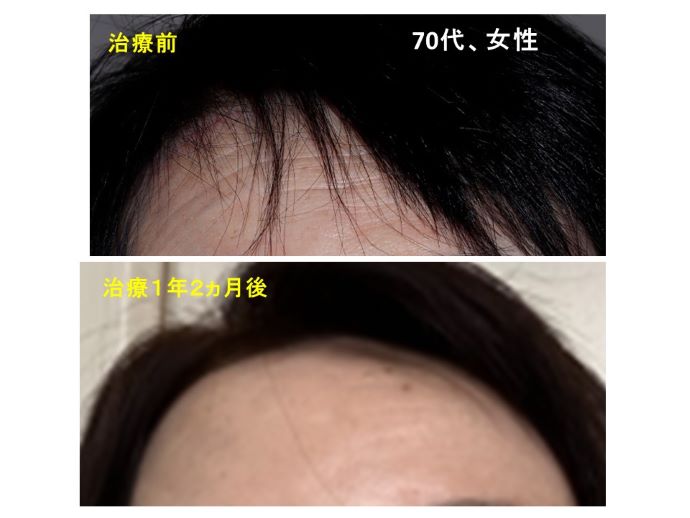 円形脱毛症　病院